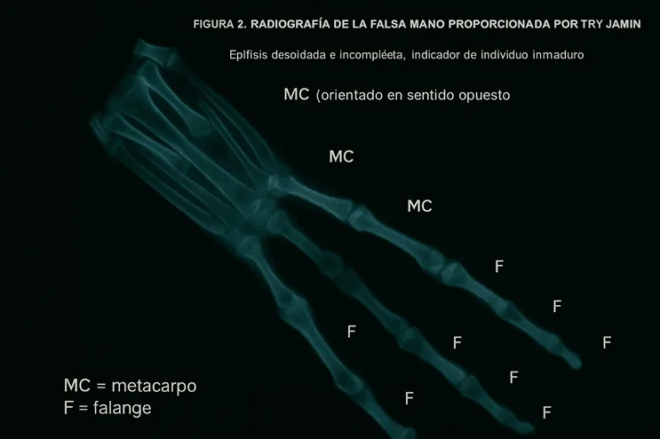 Radiografía forense de una supuesta mano tridáctila con indicaciones óseas manipuladas, utilizada en el análisis de las momias de Nazca.